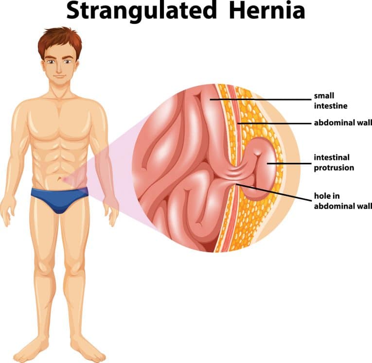 Strangulated Hernia